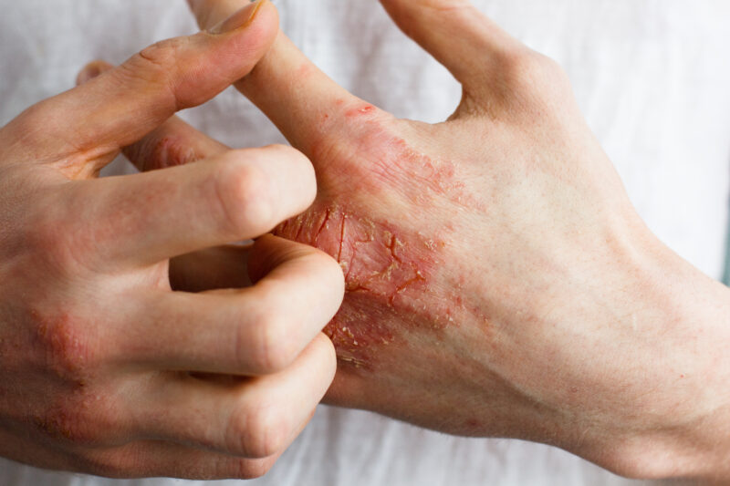 Eczema (atopic dermatitis)