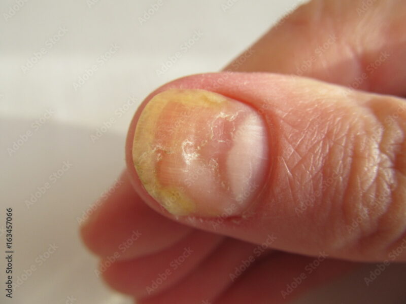 Nail disease