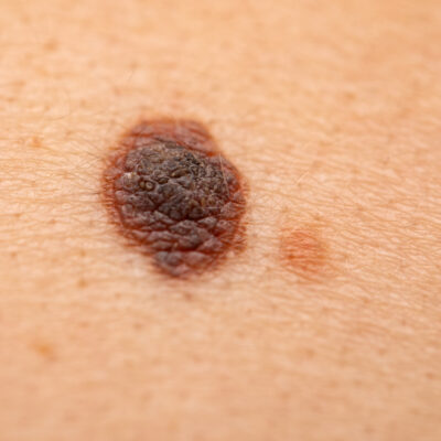 Melanoma