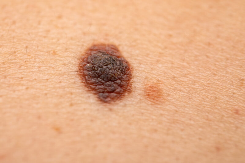 Melanoma