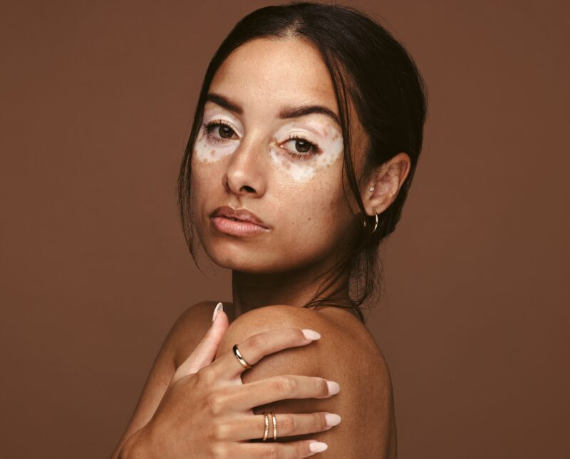 Woman with vitiligo skin condition