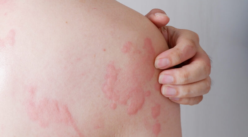 Urticaria