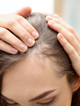 Alopecia areata hair loss