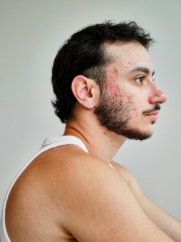Acne