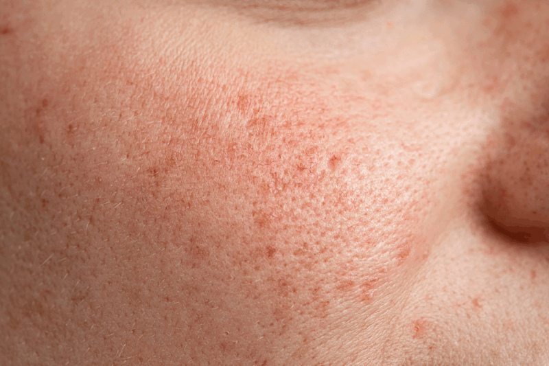 Rosacea